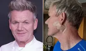 Gordon Ramsay Undergoes Surgery for Skin Cancer, Warns Fans: ‘Don’t Forget Your Sunscreen’