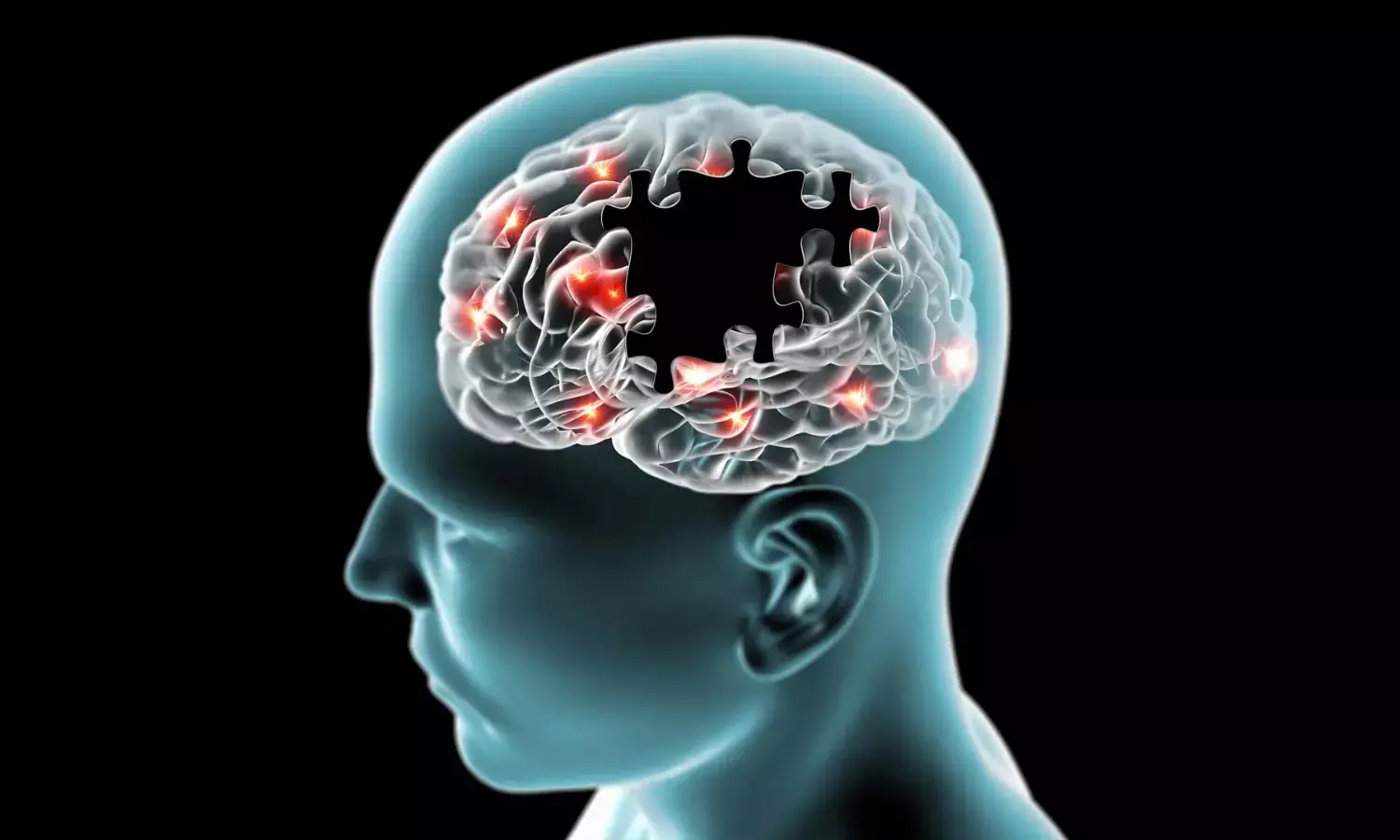The Oral-Inflammation Connection: Unraveling the Link Between Periodontitis and Multiple Sclerosis Severity