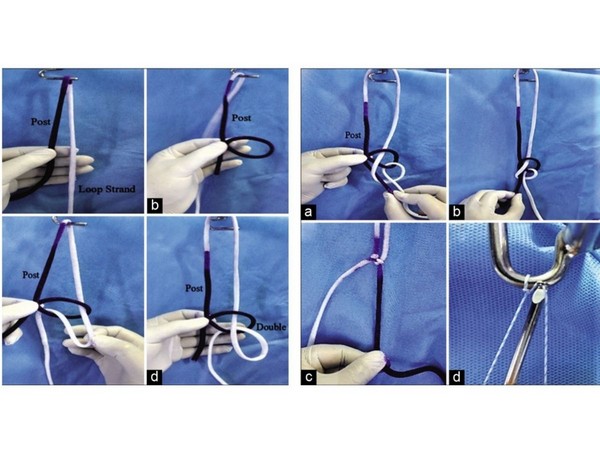 Doctor at Sakra World Hospital invents a new form of Arthroscopy knot - The Banarjis Knot