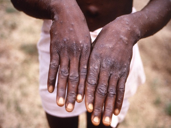 More monkeypox cases likely: WHO confirms 80 cases in 11 countries