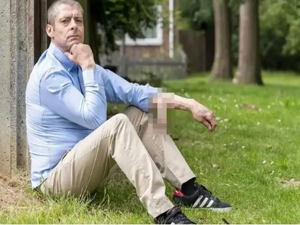 Man lost his penis, had new one attached to his arm for six years, now is a real man again