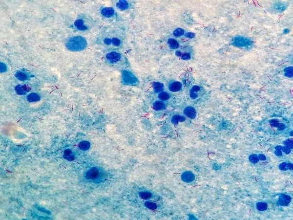 In the largest series of phage therapy case studies, more than half of the patients rate was successful: Study