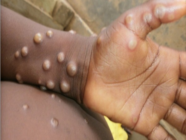 Five-year-old girl in UPs Ghaziabad with suspected Monkeypox infection tests negative