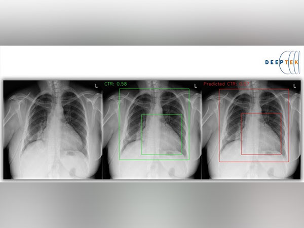 Enlarged Heart, Pulmonary Edema and Fluid in the Pleural Space Could Indicate signs of an underlying Heart Issue, can be screened by DeepTeks Path Breaking Innovative Machine Learning Technique for Digital Chest X-rays
